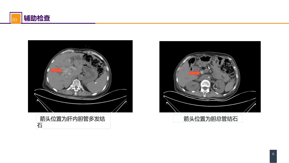 胆道疾病 案例分析-急性梗阻性化脓性胆管炎_第6页