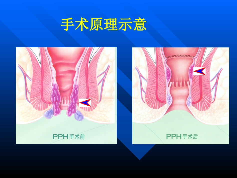 pph—治疗痔疮的新技术 ppt课件-医学资料_第13页