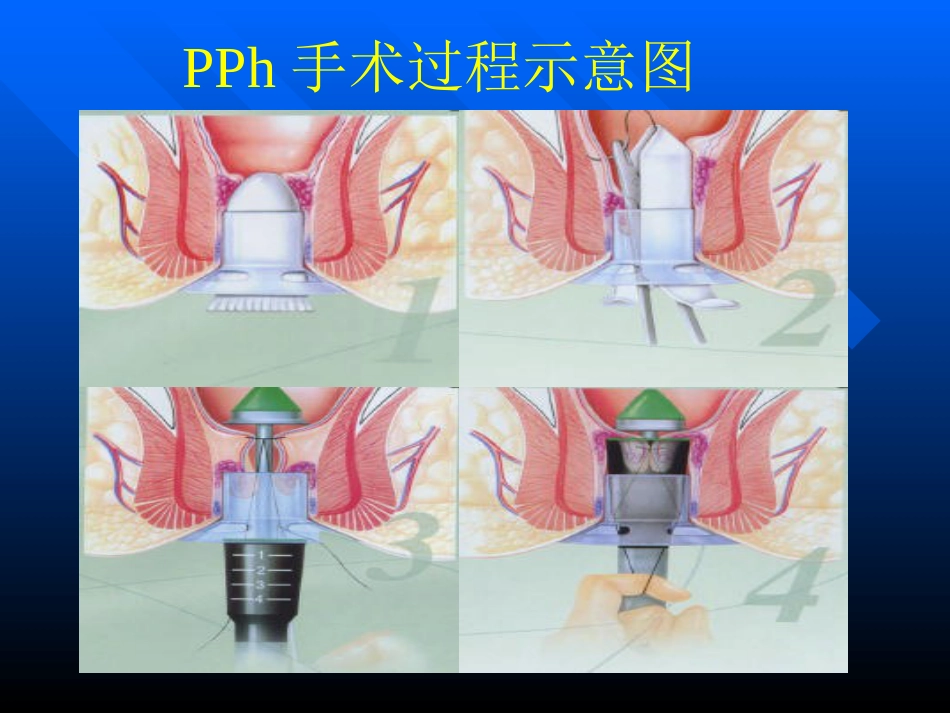 pph—治疗痔疮的新技术 ppt课件-医学资料_第14页