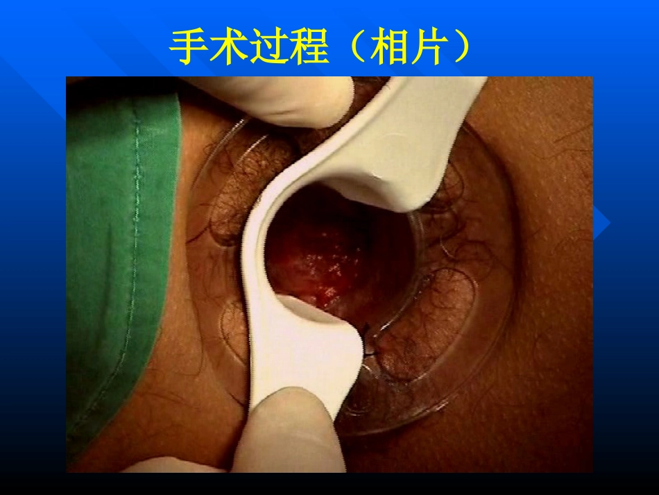 pph—治疗痔疮的新技术 ppt课件-医学资料_第15页