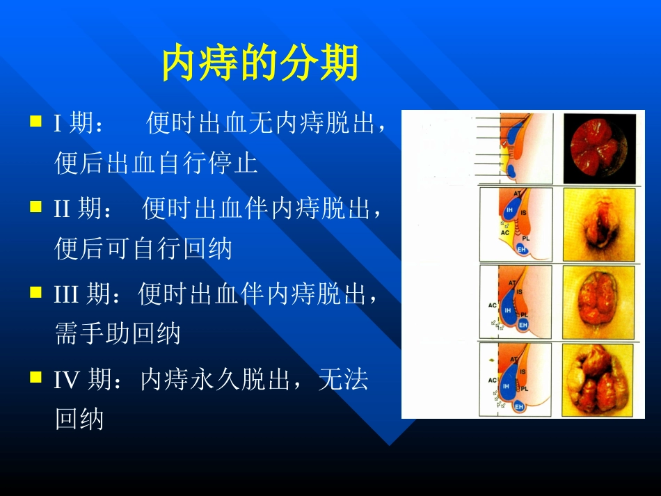 pph—治疗痔疮的新技术 ppt课件-医学资料_第8页