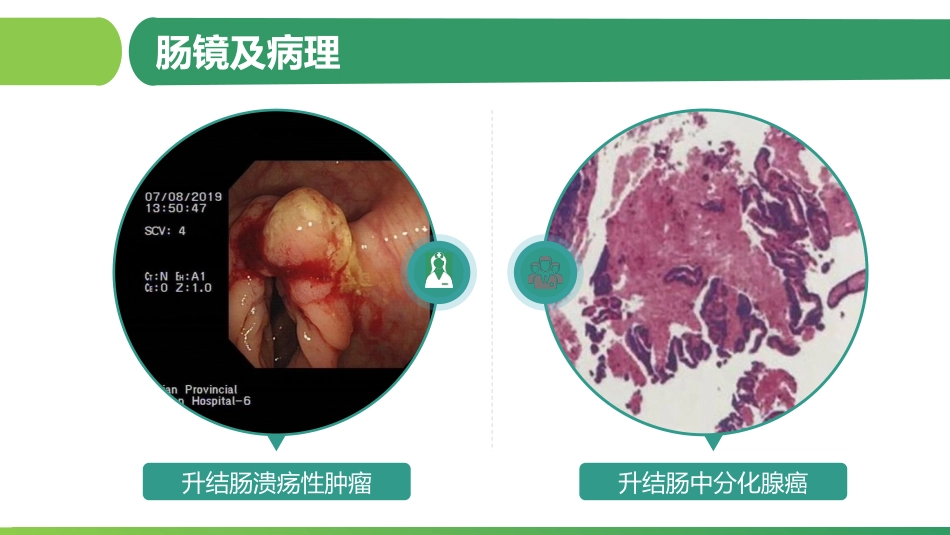 ERAS促进结肠癌术后快速康复_第4页