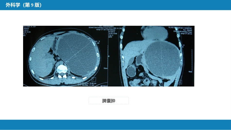 脾疾病_第9页