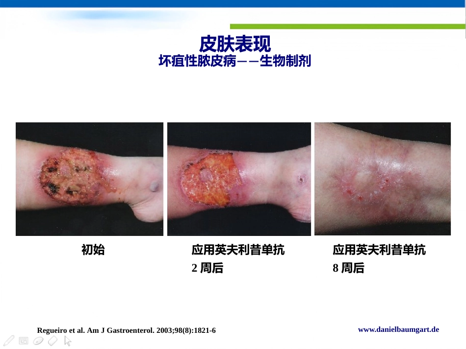 IBD肠外表现的新视角Daniel C Baumgart中文版_第12页