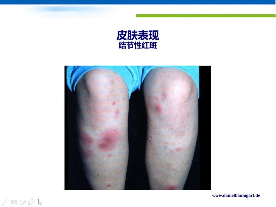 IBD肠外表现的新视角Daniel C Baumgart中文版_第14页