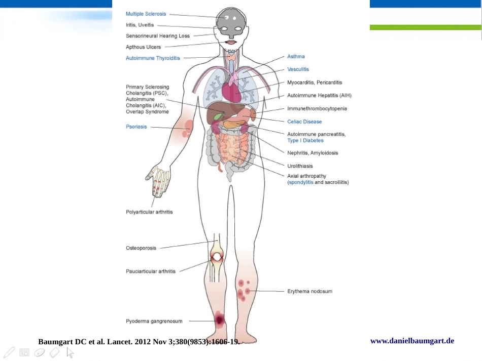 IBD肠外表现的新视角Daniel C Baumgart中文版_第2页