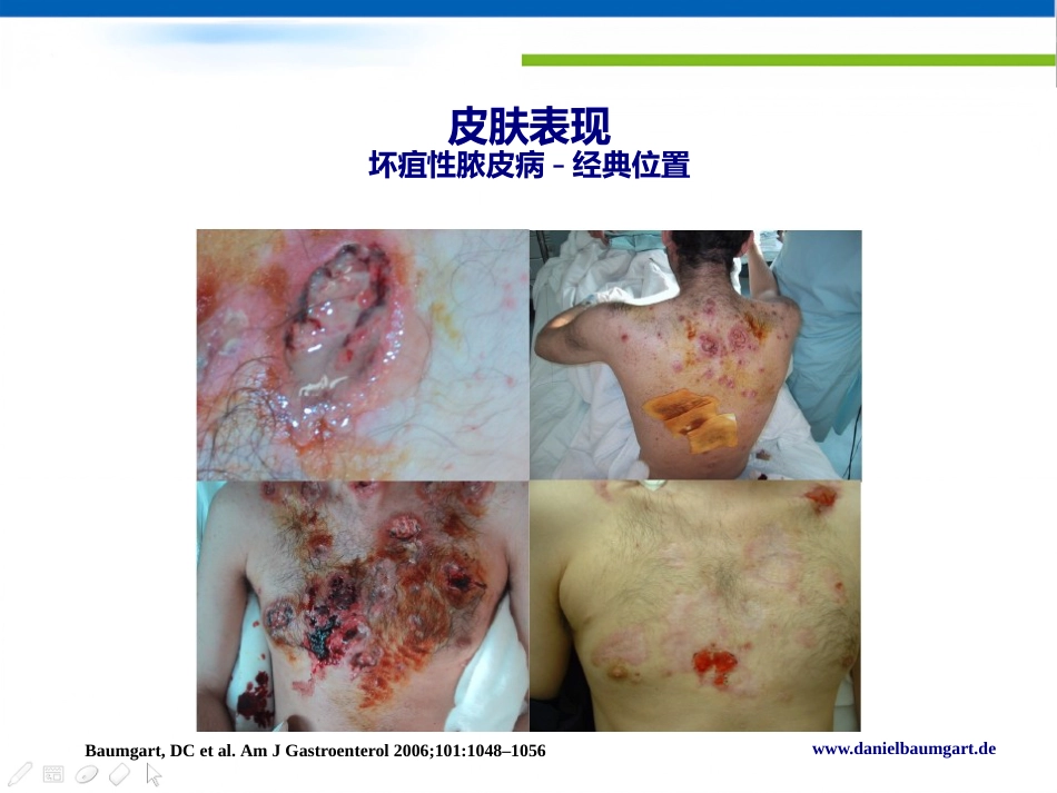 IBD肠外表现的新视角Daniel C Baumgart中文版_第8页