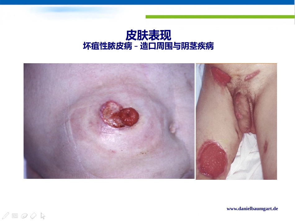 IBD肠外表现的新视角Daniel C Baumgart中文版_第9页