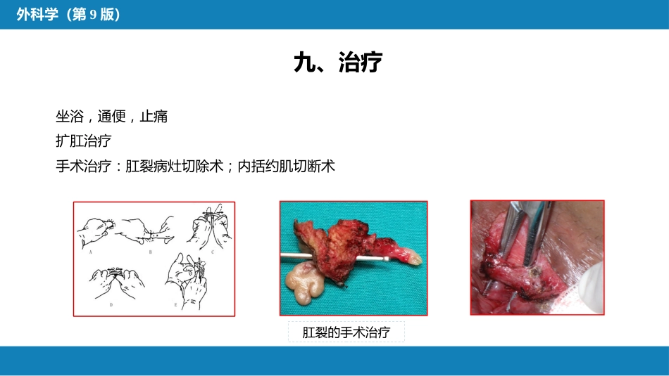 结、直肠与肛管疾病 第九、十、十一节 (1)_第8页