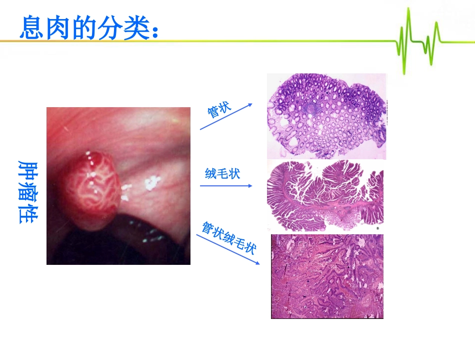 emr治疗肠道息肉36页PPT(1)_第5页