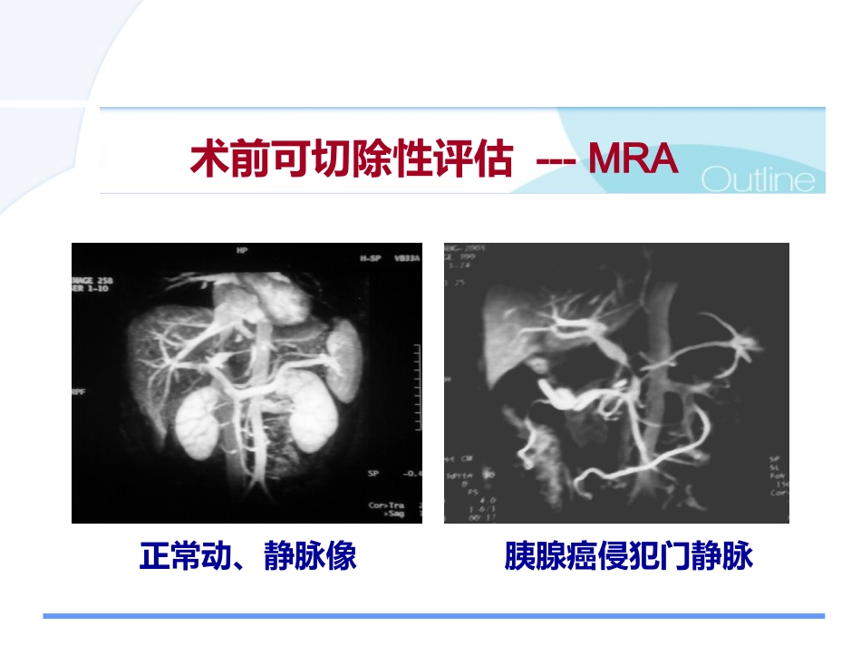 胰腺癌诊治的难点问题pps_第15页