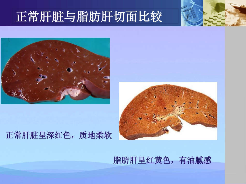 年脂肪肝健康教育资料PPT_第7页
