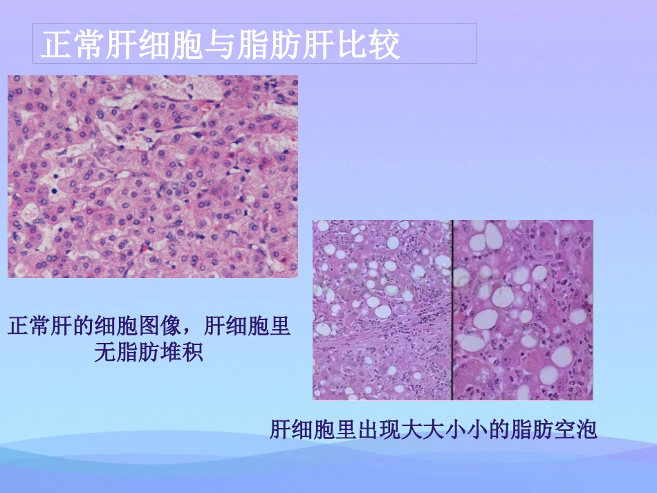年脂肪肝健康教育资料PPT_第8页