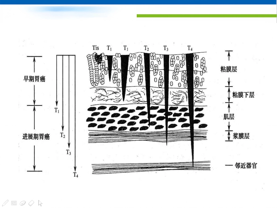 年胃癌诊治策略_第5页