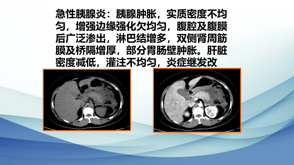 年急性胰腺炎液体复苏_第3页