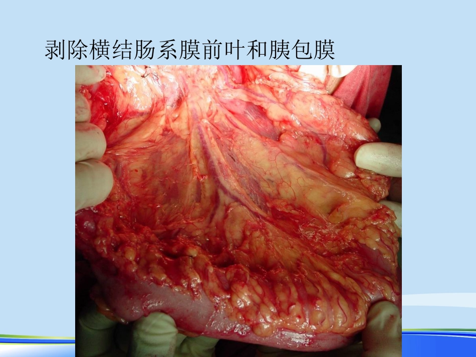 年规范化胃癌根治术PPT_第10页