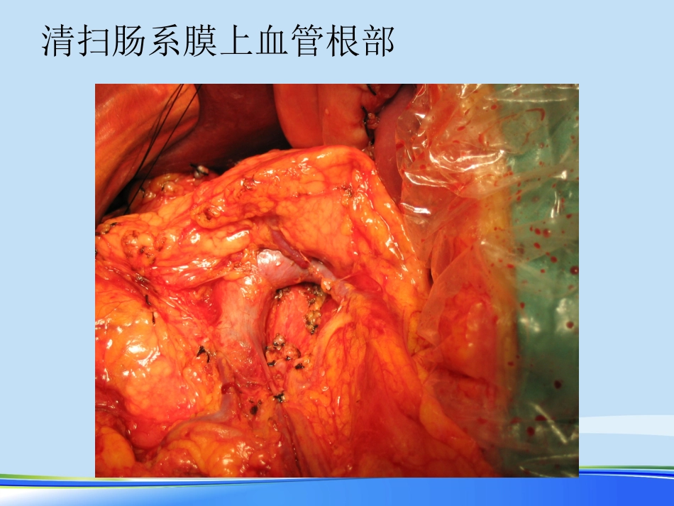 年规范化胃癌根治术PPT_第12页