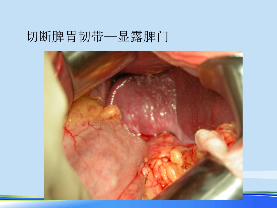 年规范化胃癌根治术PPT_第14页