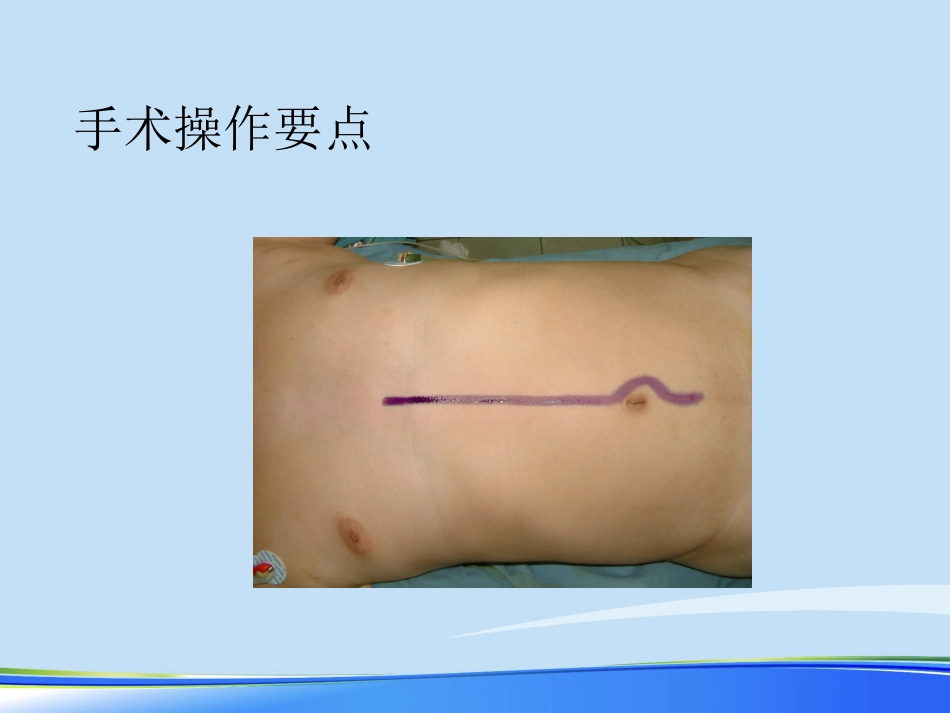 年规范化胃癌根治术PPT_第8页