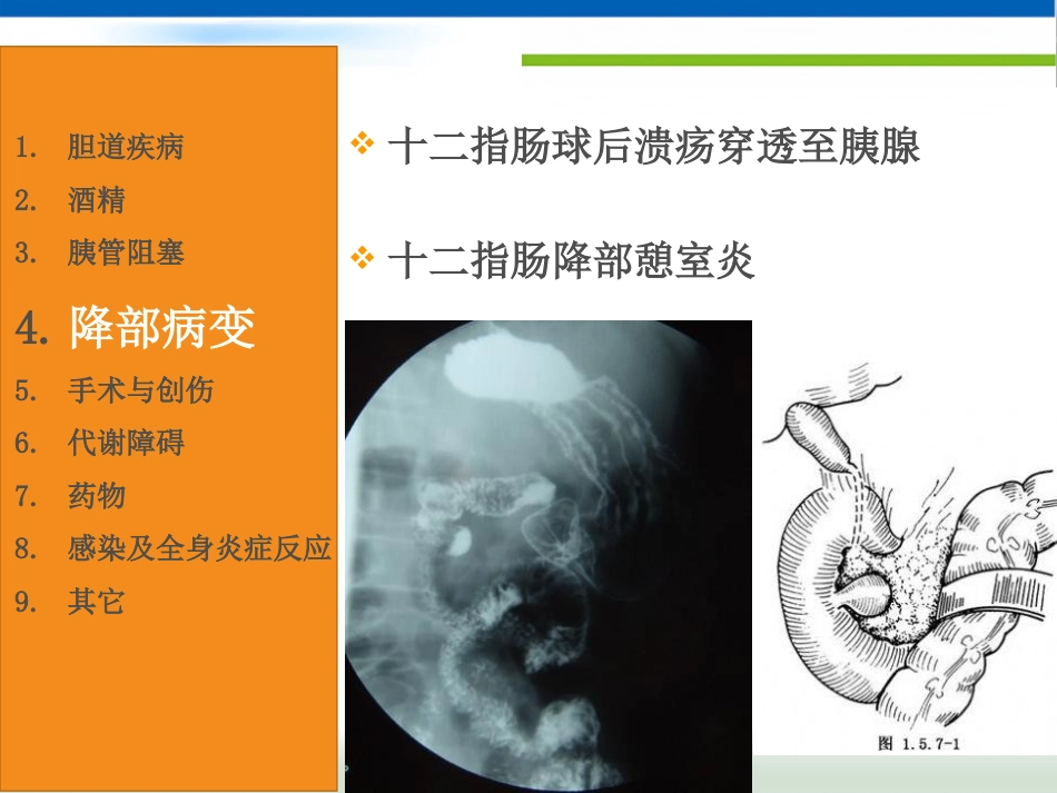 急性胰腺炎(1)_第9页
