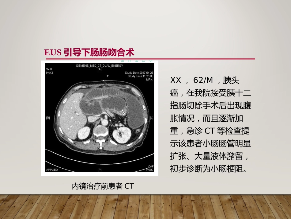 EUS在部分消化道梗阻性疾病中的应用_第13页