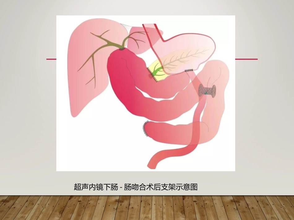 EUS在部分消化道梗阻性疾病中的应用_第14页
