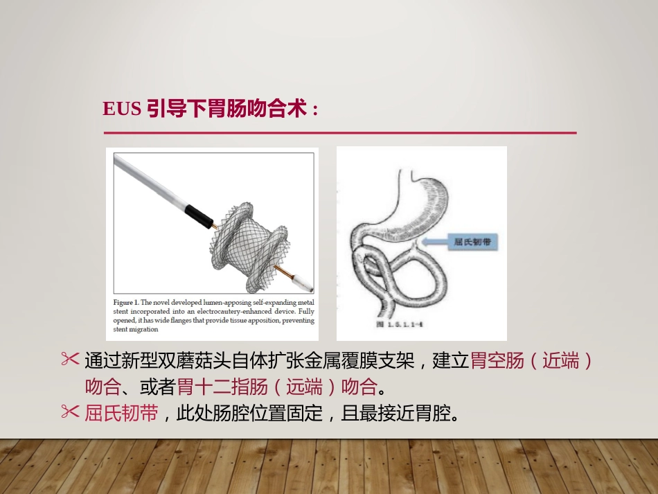 EUS在部分消化道梗阻性疾病中的应用_第5页