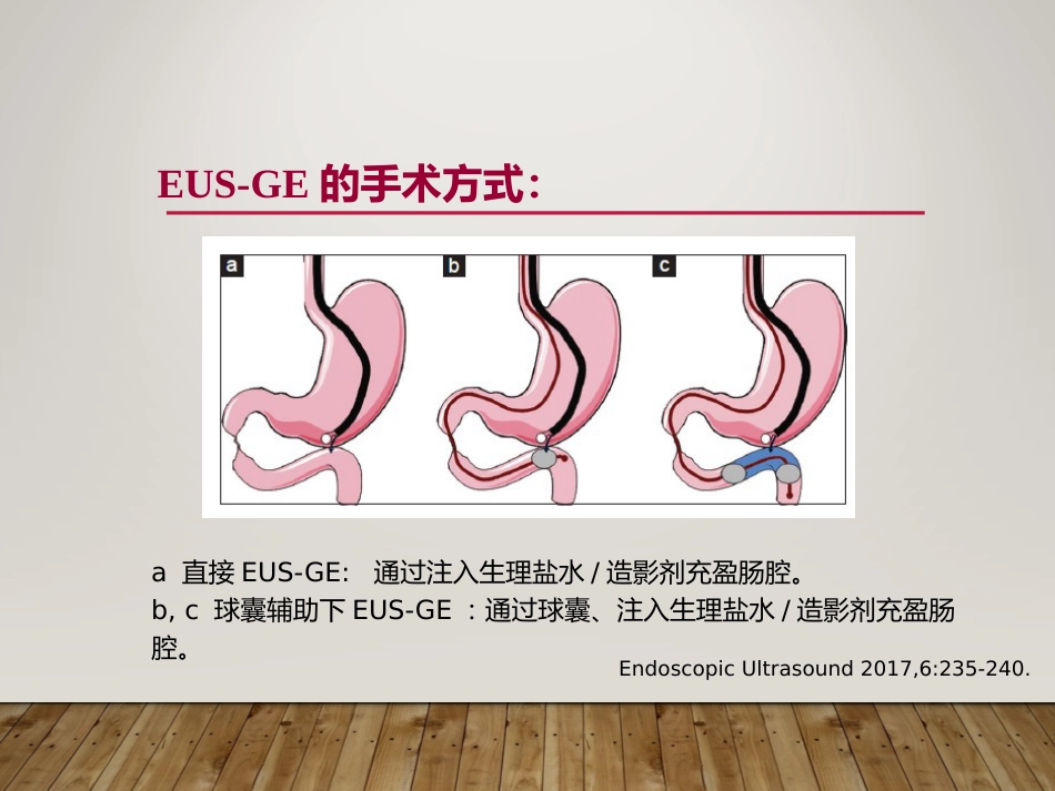 EUS在部分消化道梗阻性疾病中的应用_第7页