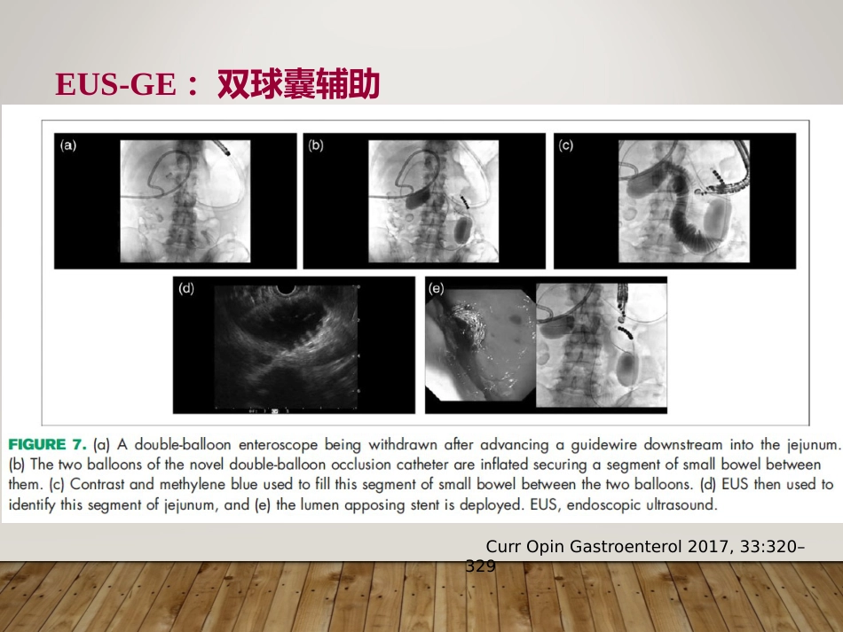 EUS在部分消化道梗阻性疾病中的应用_第8页