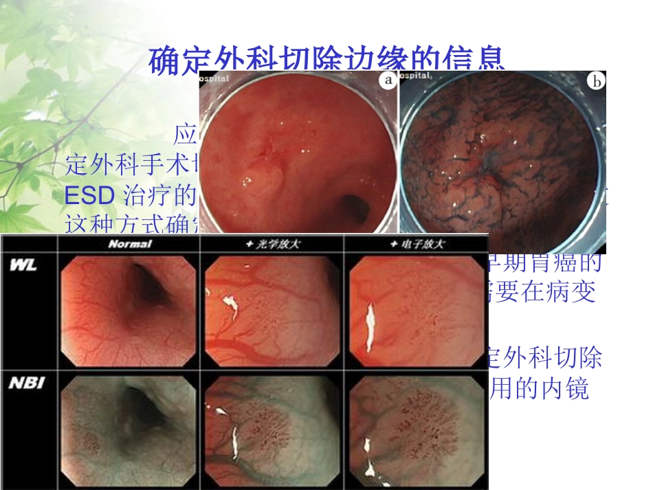 ESD治疗早期胃癌_第13页