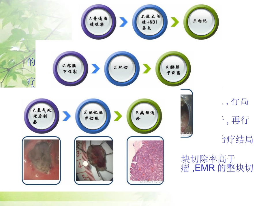 ESD治疗早期胃癌_第14页