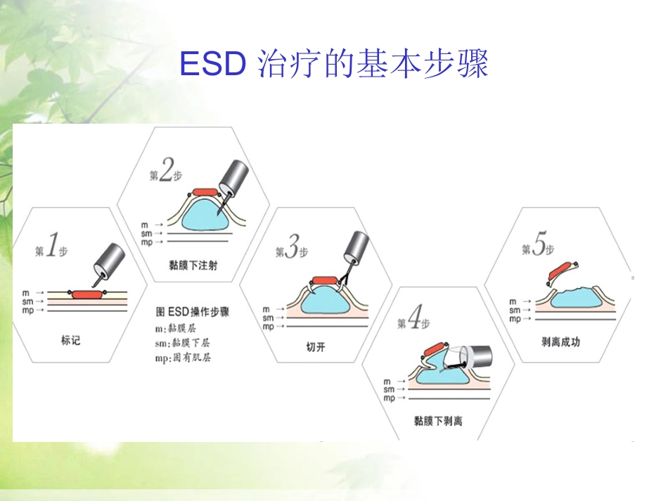 ESD治疗早期胃癌_第4页