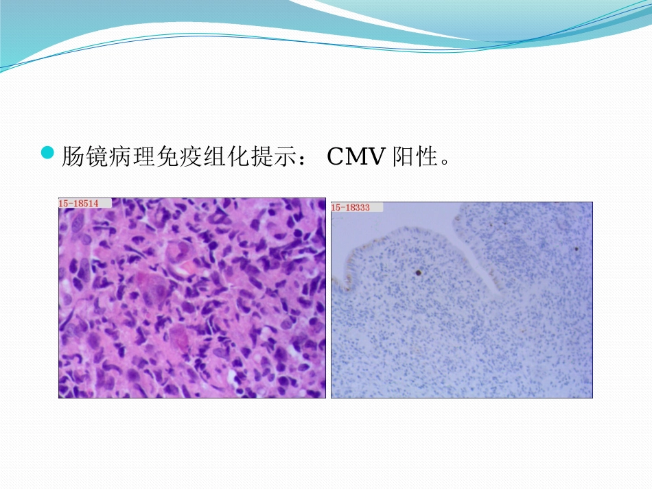 CMV肠炎一例分享x_第15页