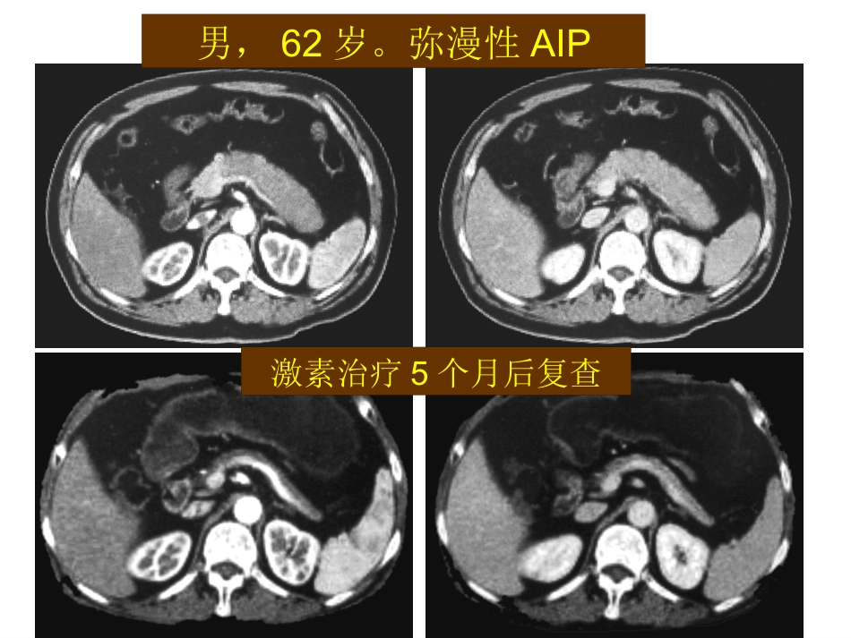 自身免疫性胰腺炎_第10页