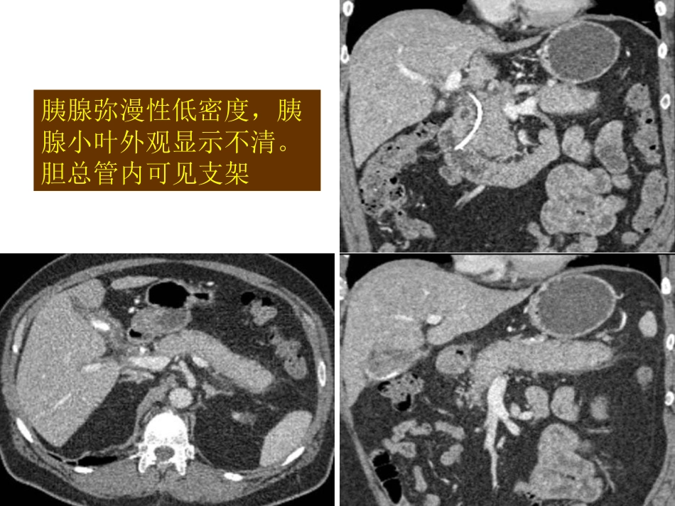 自身免疫性胰腺炎_第11页