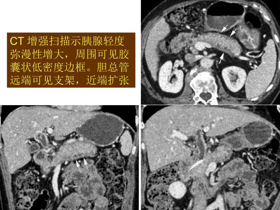 自身免疫性胰腺炎_第12页