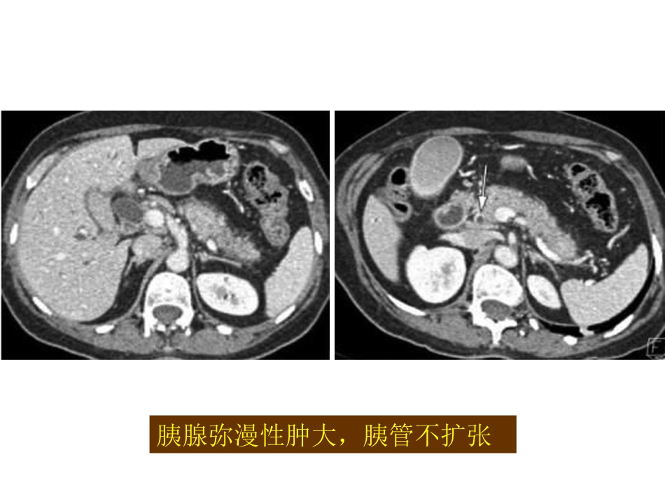 自身免疫性胰腺炎_第13页