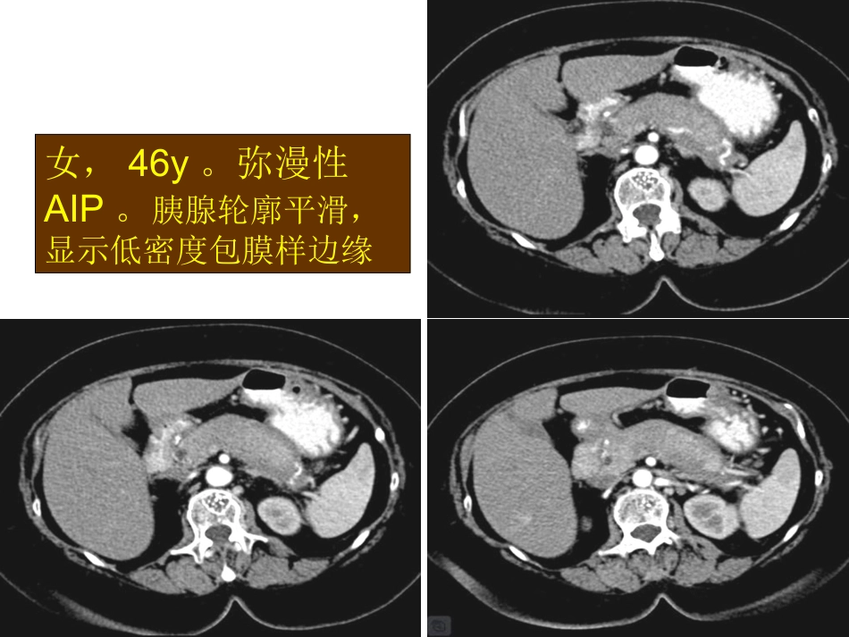 自身免疫性胰腺炎_第14页