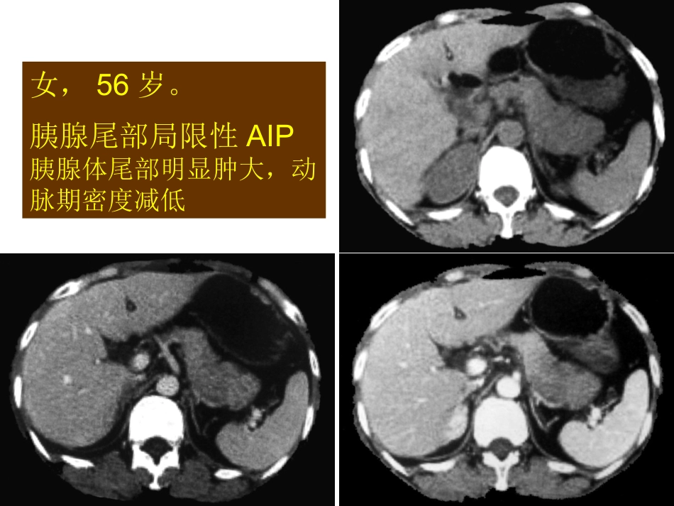 自身免疫性胰腺炎_第15页