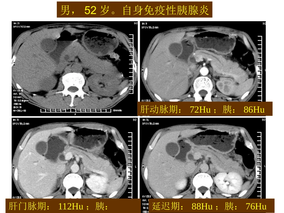 自身免疫性胰腺炎_第8页