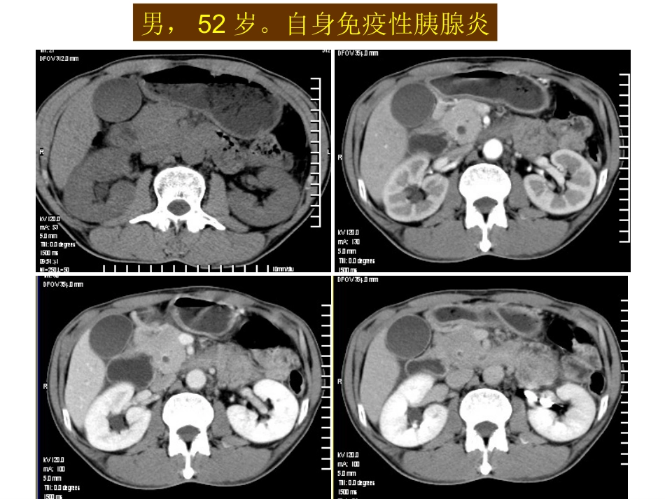 自身免疫性胰腺炎_第9页