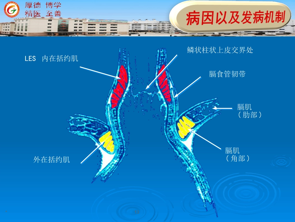 版内科 胃食管反流病_第13页