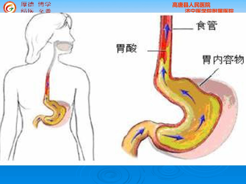 版内科 胃食管反流病_第5页