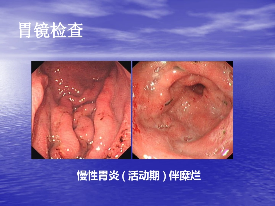 NSAID相关性胃肠病医学PPT_第7页