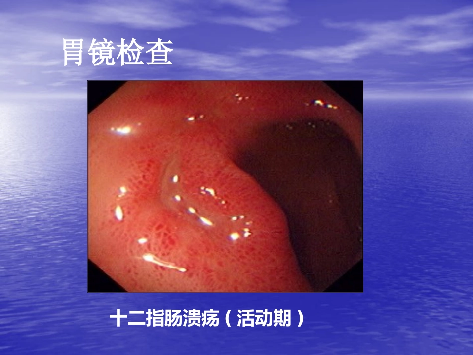 NSAID相关性胃肠病医学PPT_第8页