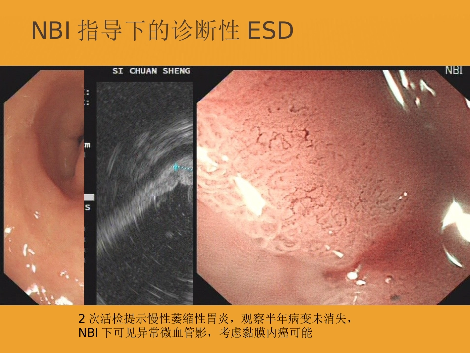 NBI-ME诊断早期胃癌技巧_第10页
