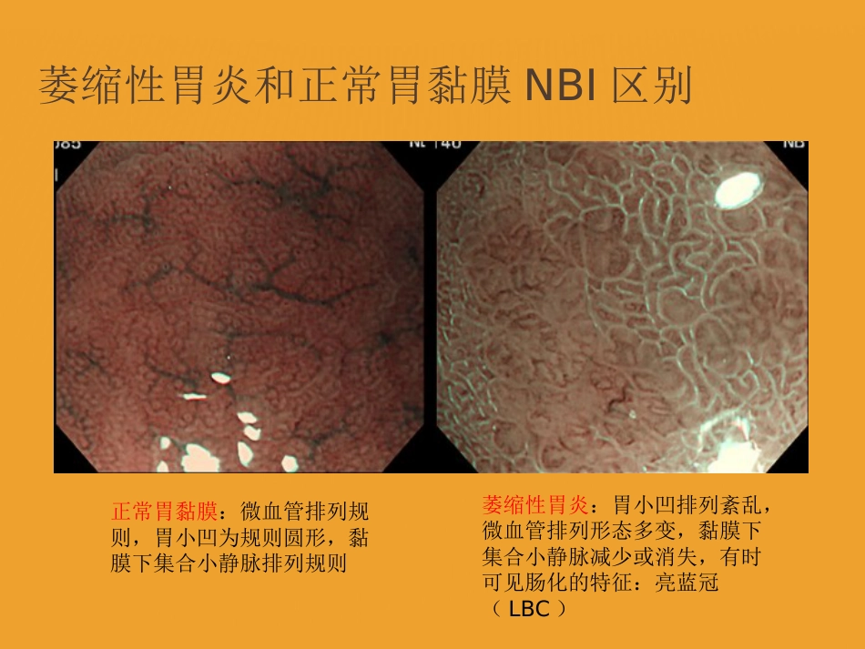 NBI-ME诊断早期胃癌技巧_第3页