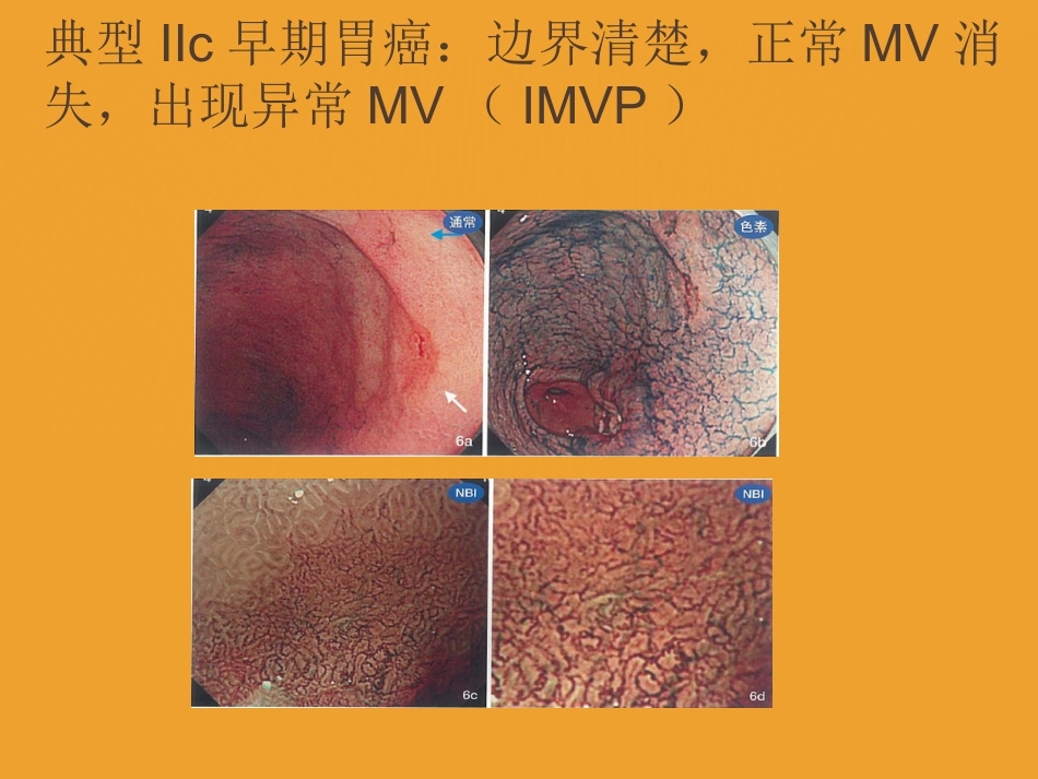 NBI-ME诊断早期胃癌技巧_第4页