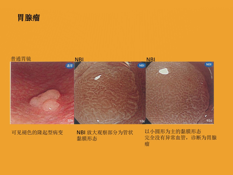 NBI-ME诊断早期胃癌技巧_第5页
