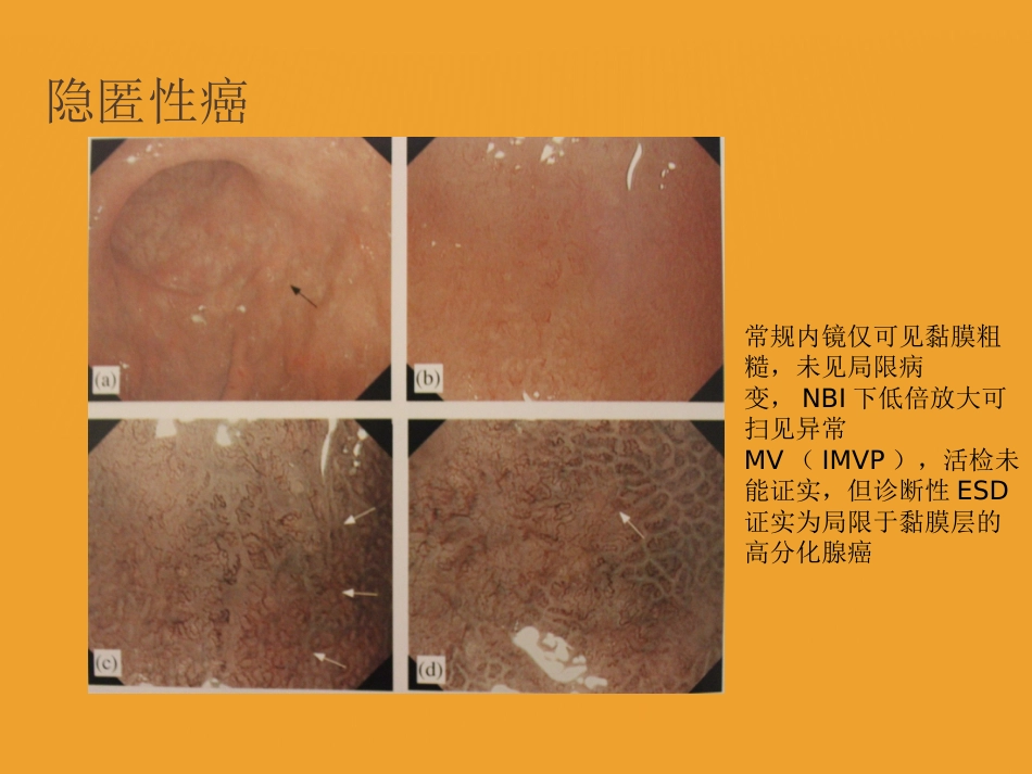 NBI-ME诊断早期胃癌技巧_第6页